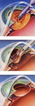 Cataract surgery. Surgical services Ophthalmologic Clinic Klinika Zir